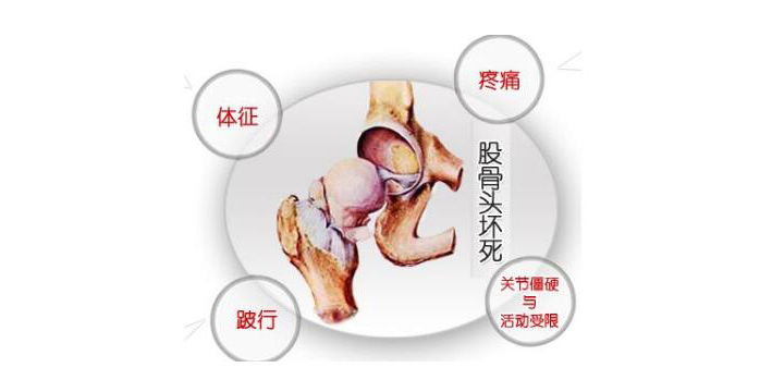 股骨头坏死