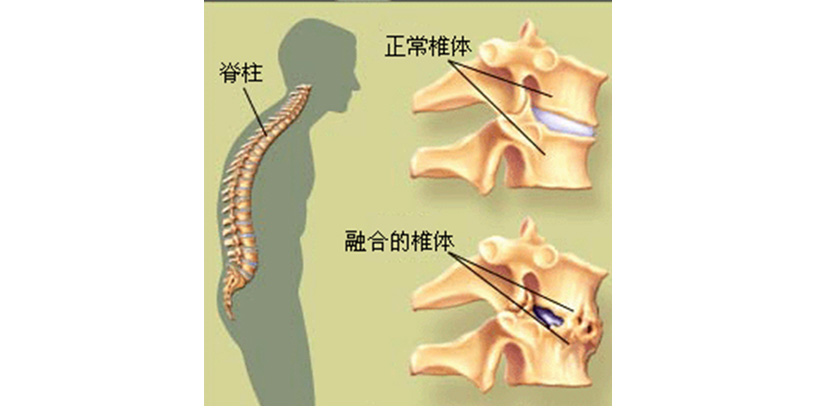 强直性脊柱炎