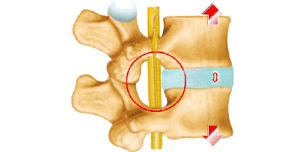 腰间盘突出